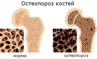 Остеопороз: диагностика, лечение и профилактика